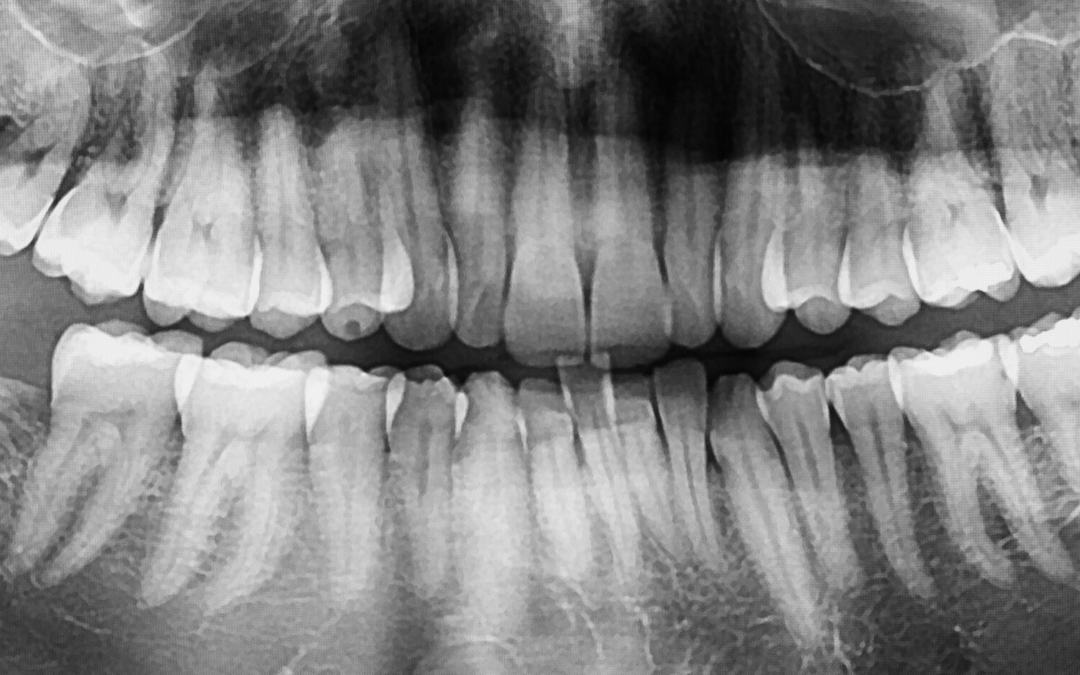Why does my dentist need to take x-rays?