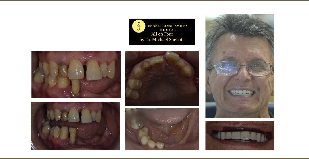 Do You Need to Remove Existing Teeth Before All on 4 Implants?