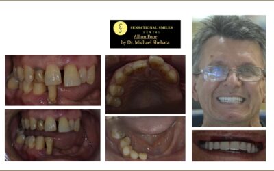 teeth-replacement-img-11-2