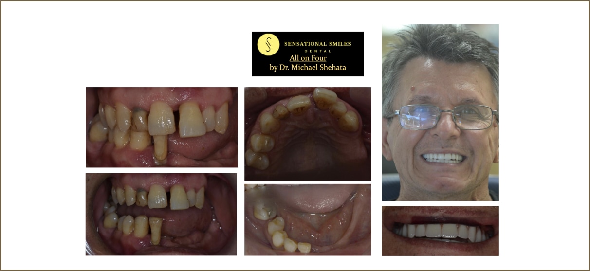 teeth-replacement-img-11-2