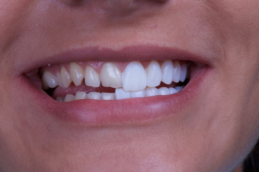 Dental Veneers: Are They Worth the Cost?