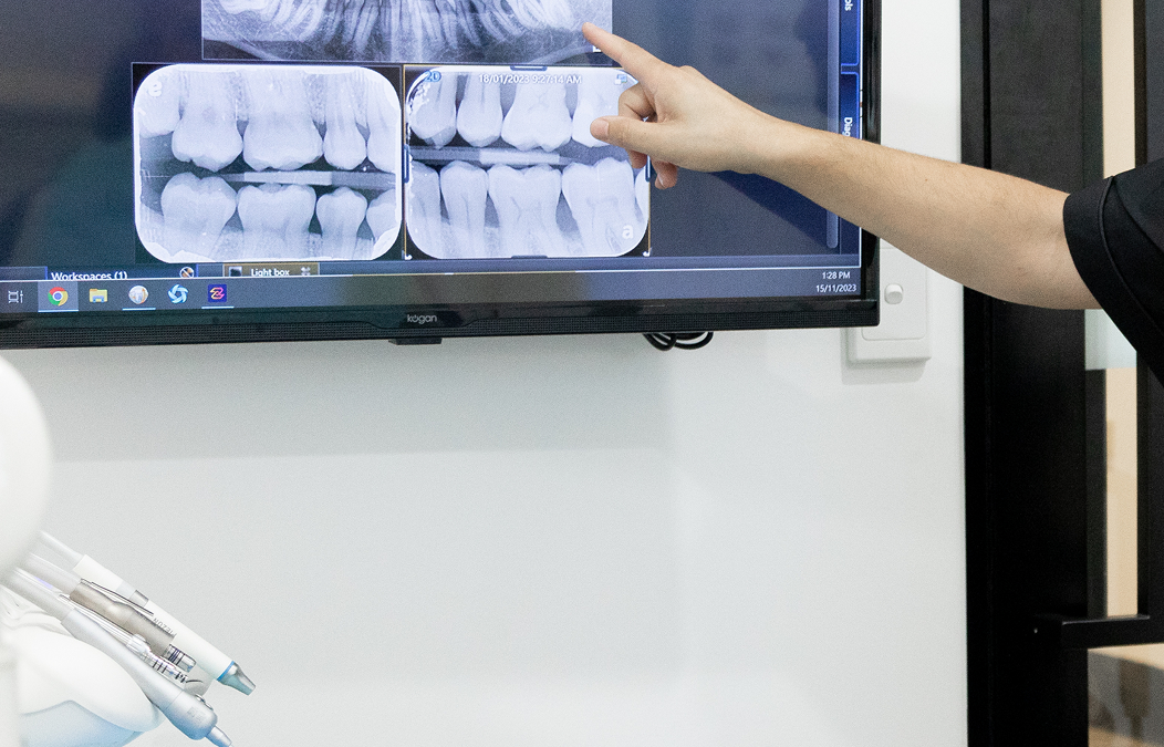 What You Should Know About Bone Loss and Dental Implants